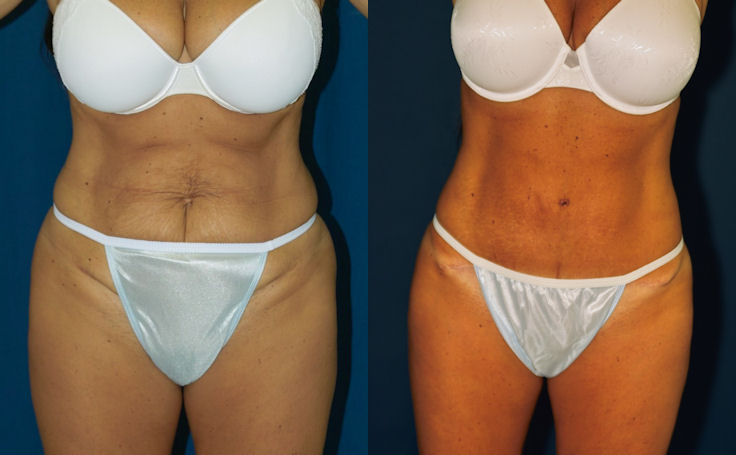 Before and after photo of an actual Tummy Tuck patient.