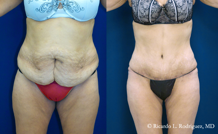 Before and after photo of an actual Tummy Tuck patient.