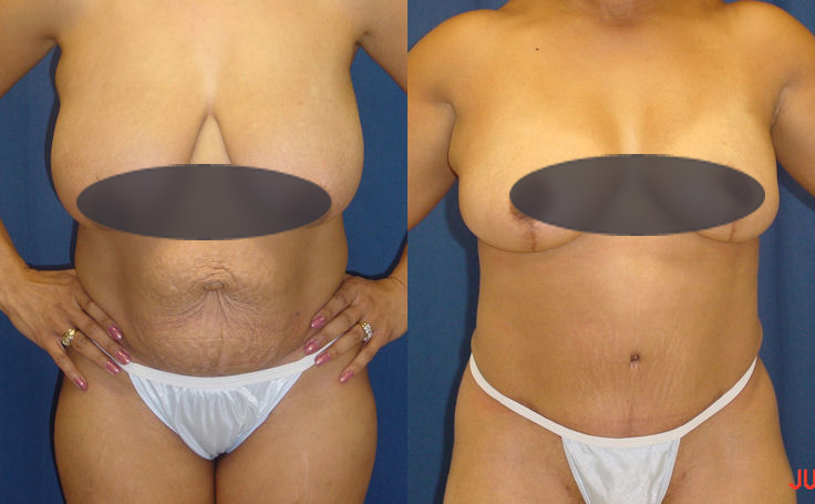 Before and after photo of an actual Tummy Tuck patient.