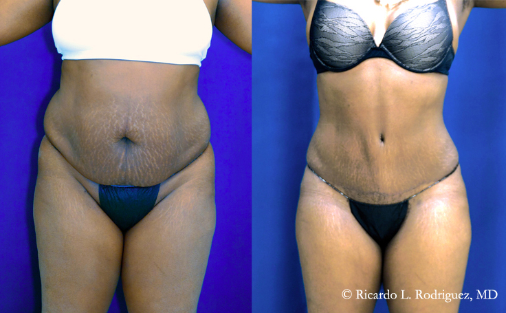 Before and after photo of an actual Tummy Tuck patient.