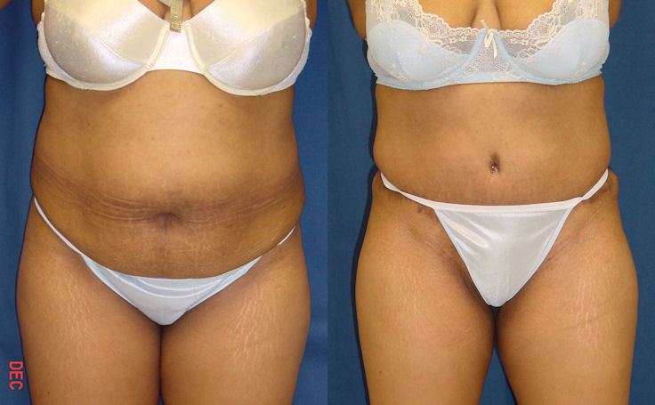 Before and after photo of an actual Tummy Tuck patient.