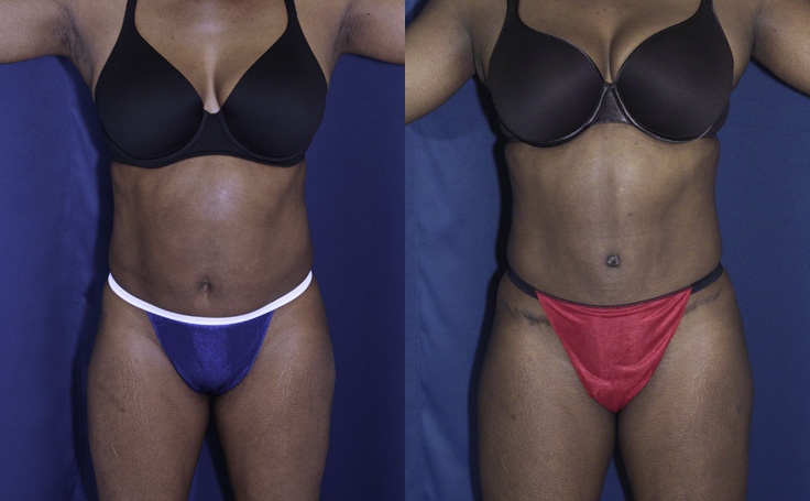 Before and after photo of an actual Tummy Tuck patient.