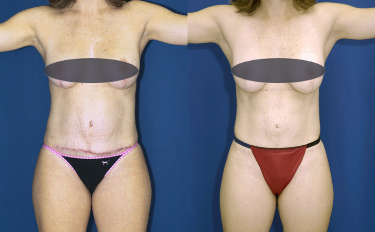 Before and after photo of an actual Tummy Tuck patient.