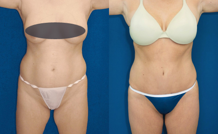 Before and after photo of an actual Tummy Tuck patient.