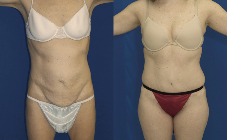 Before and after photo of an actual Tummy Tuck patient.