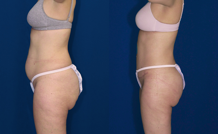 Before and after photo of an actual Tummy Tuck patient.