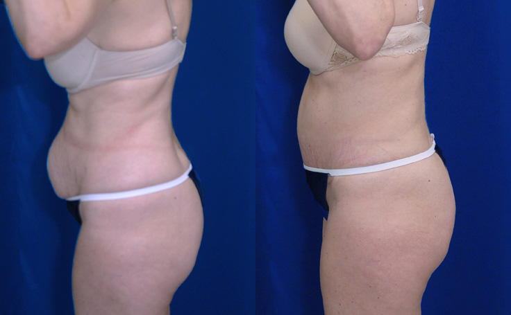 Before and after photo of an actual Tummy Tuck patient.