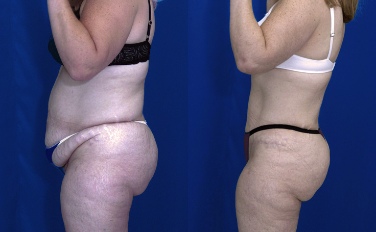 Before and after photo of an actual Tummy Tuck patient.