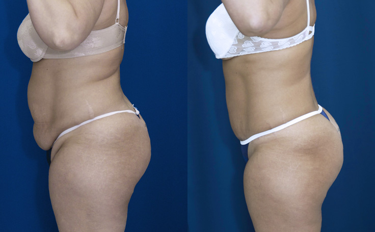 Before and after photo of an actual Tummy Tuck patient.