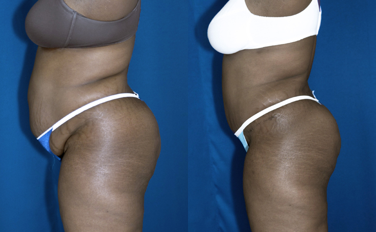 Before and after photo of an actual Tummy Tuck patient.