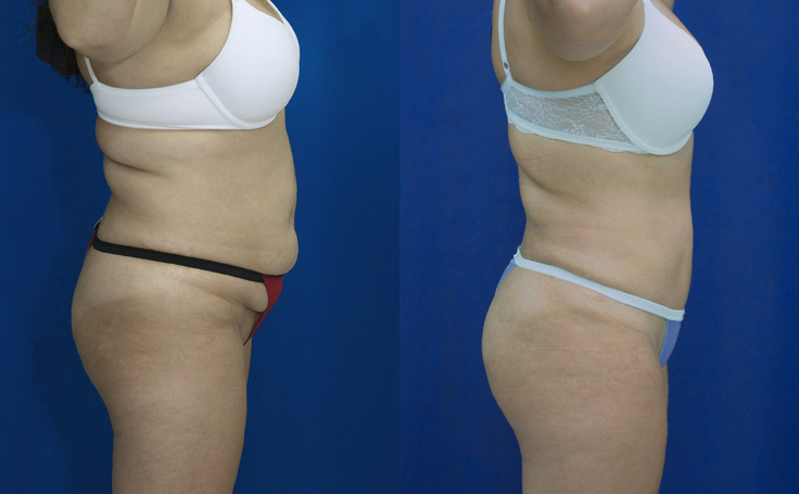 Before and after photo of an actual Tummy Tuck patient.