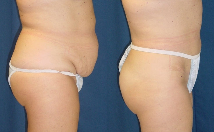 Before and after photo of an actual Tummy Tuck patient.