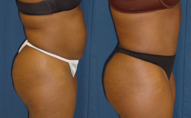 Before and after photo of an actual Tummy Tuck patient.