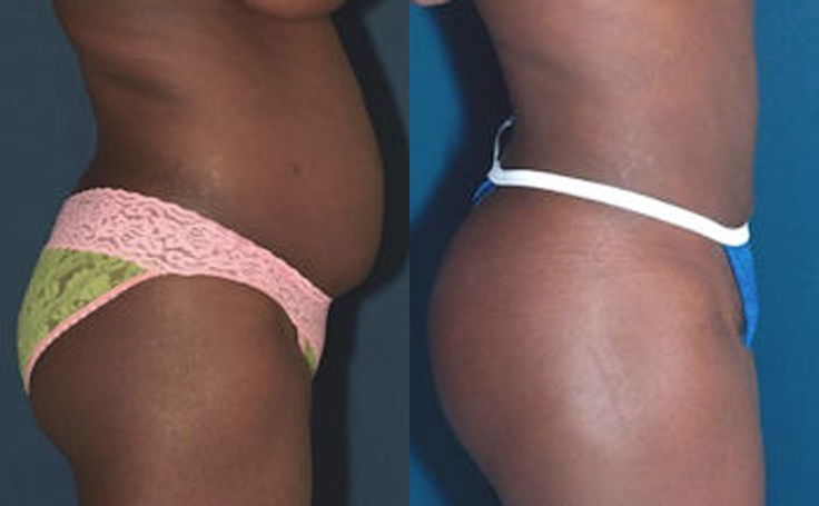 Before and after photo of an actual Tummy Tuck patient.