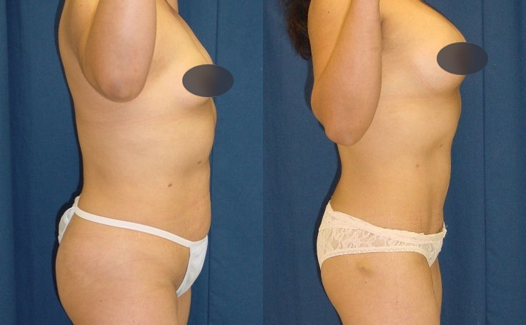 Before and after photo of an actual Tummy Tuck patient.