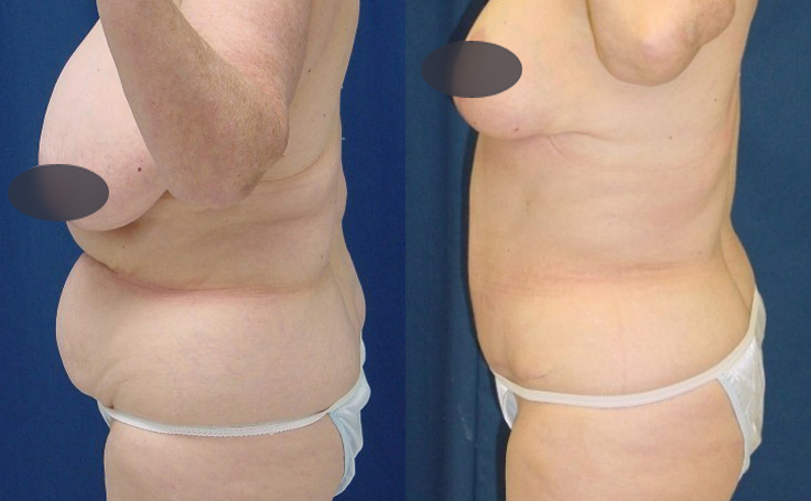 Before and after photo of an actual Tummy Tuck patient.