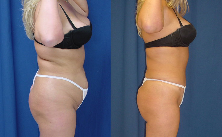 Before and after photo of an actual Tummy Tuck patient.