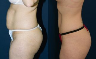 Before and after photo of an actual Tummy Tuck patient.