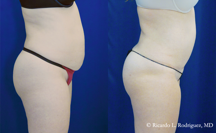 Before and after photo of an actual Tummy Tuck patient.