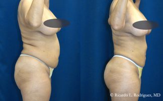 Before and after photo of an actual Tummy Tuck patient.