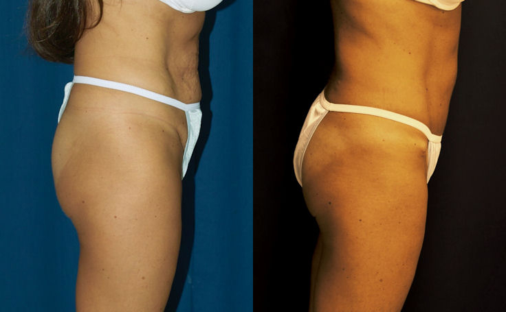 Before and after photo of an actual Tummy Tuck patient.