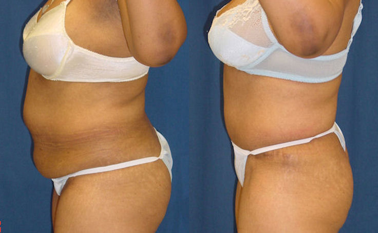 Before and after photo of an actual Tummy Tuck patient.