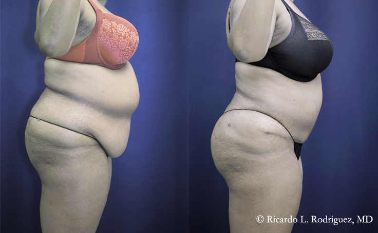 Before and after photo of an actual Tummy Tuck patient.