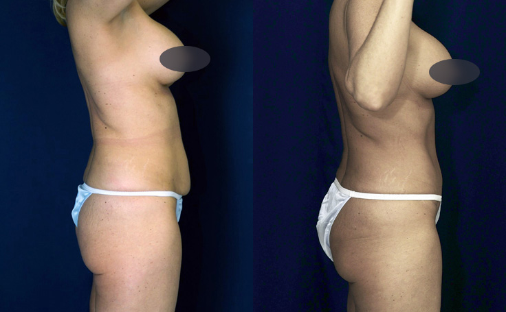 Before and after photo of an actual Tummy Tuck patient.