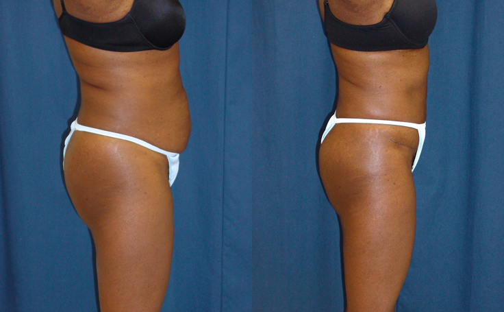 Before and after photo of an actual Tummy Tuck patient.