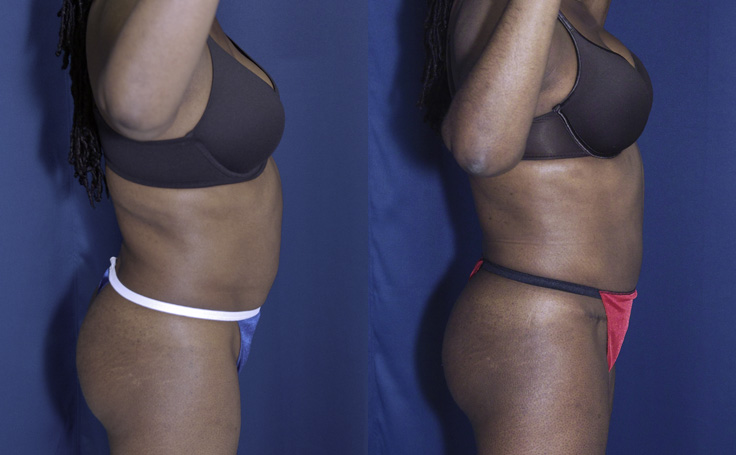 Before & After Lipo of flanks - Dr. Rodriguez, Cosmeticsurg