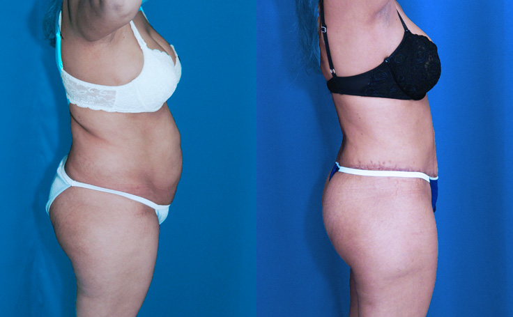 Before and after photo of an actual Tummy Tuck patient.