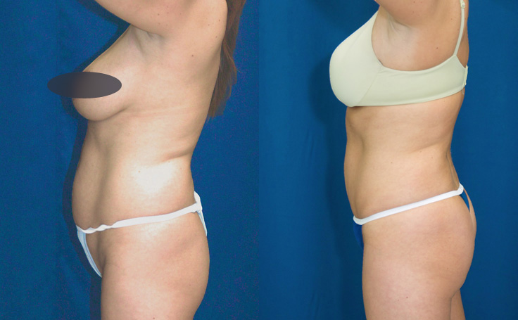 Before and after photo of an actual Tummy Tuck patient.