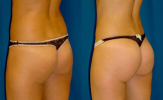 before and after brazilian butt lift results