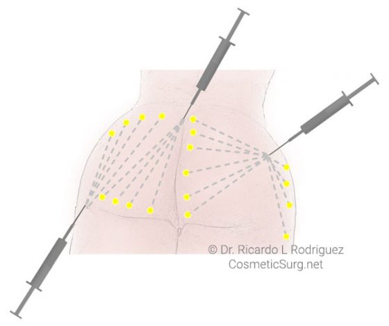 illustration of fat injection paths during brazilian butt lift surgery