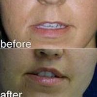 A collage of photos of a patient's mouth, showing her lips before and after a lip lift procedure.