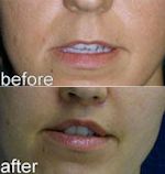 A collage of photos of a patient's mouth, showing her lips before and after a lip lift procedure.