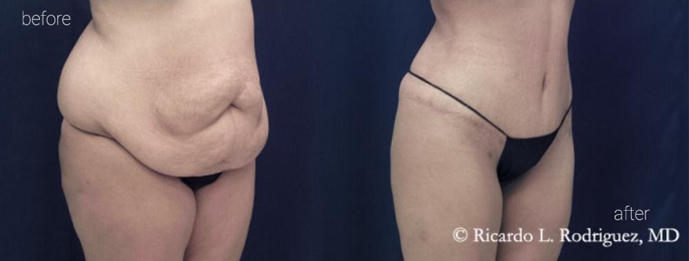 Before and after tummy tuck showing removal of excess abdominal skin and improved contour