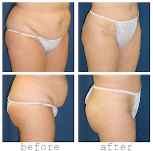 A collage of photos of a patient, from different angles, before and after a Tummy tuck procedure.