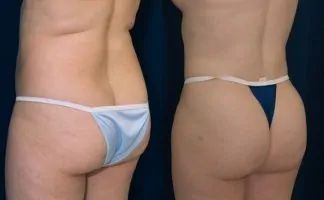 Before and after photo of an actual B-more Butt Lift patient.