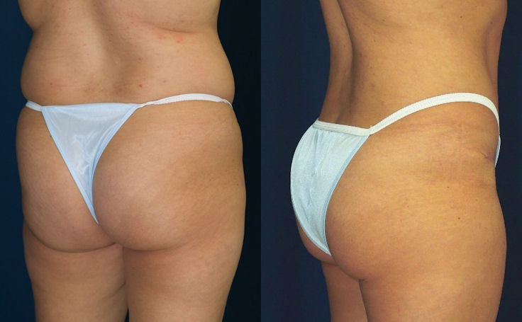 Before and after photo of an actual B-more Butt Lift patient.