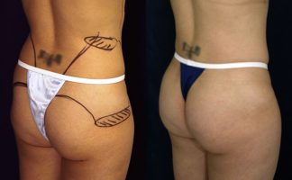Before and after photo of an actual B-more Butt Lift patient.