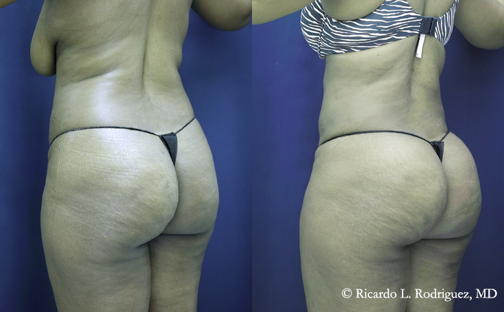 before and after photos of a woman who had a b'more butt lift that removed 4000 cc of fat