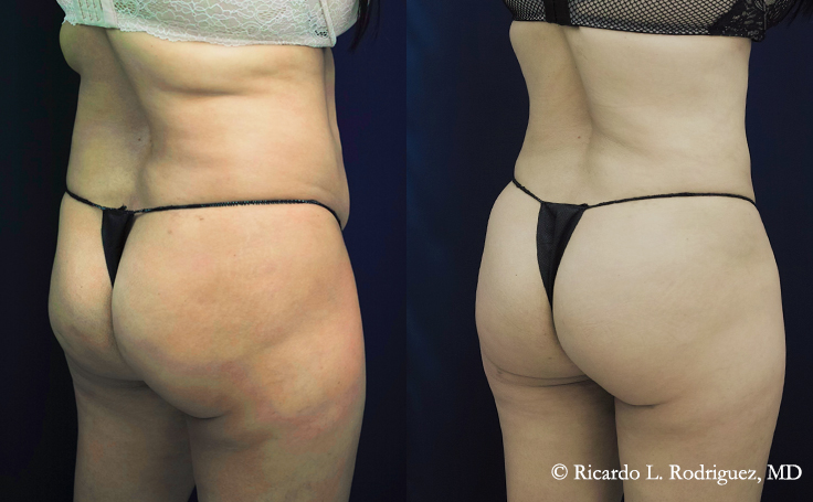 before and after a b'more butt lift patient back side angle view