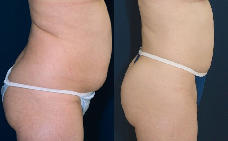 Before and after photo of an actual B-more Butt Lift patient.