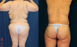 Before and after photo of an actual Body Lift patient.