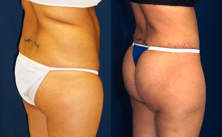 Before and after photo of an actual Body Lift patient.