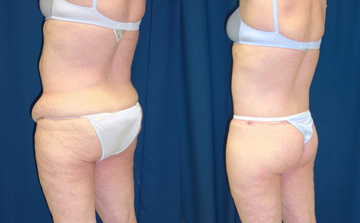 Before and after photo of an actual Body Lift patient.