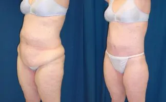 Body lift (Lower body lift, Belt lipectomy) - Dr. Rodriguez, Cosmeticsurg -  Baltimore