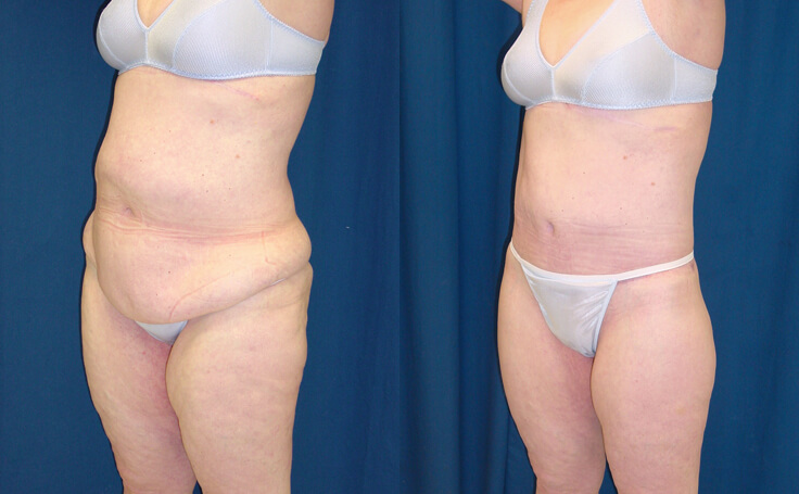 Before and after photo of an actual Body Lift patient.