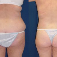 belt lipectomy
